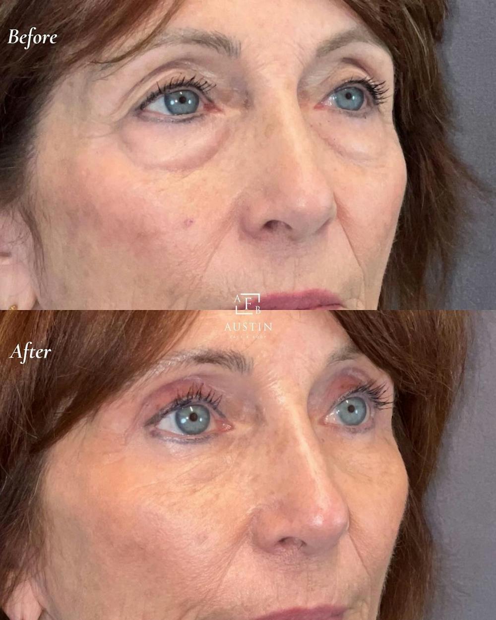 Upper Blepharoplasty Before & After Gallery - Patient 149257988 - Image 3