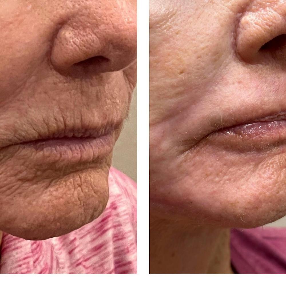 Laser Resurfacing Before & After Gallery - Patient 146179 - Image 1