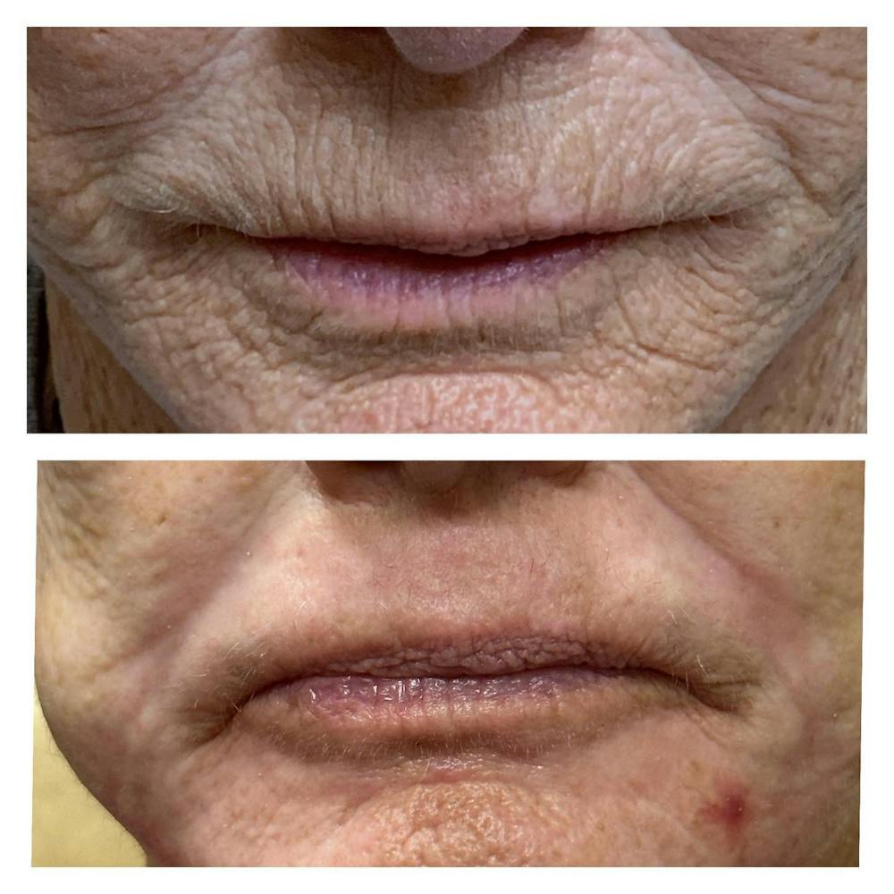 Laser Resurfacing Before & After Gallery - Patient 146179 - Image 2