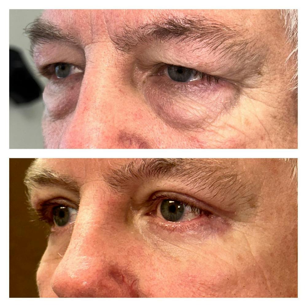 Upper Blepharoplasty Before & After Gallery - Patient 149283994 - Image 1