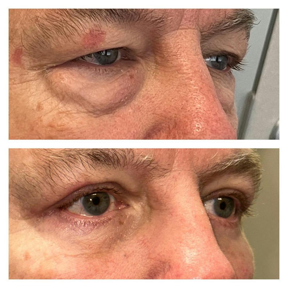 Lower Blepharoplasty Before & After Gallery - Patient 149283996 - Image 2