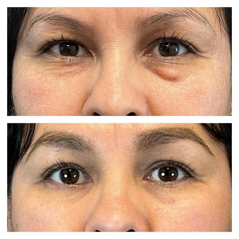Lower Blepharoplasty Before & After Gallery - Patient 149283997 - Image 1
