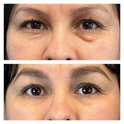 Lower Blepharoplasty Before & After Gallery - Patient 149283997 - Image 1
