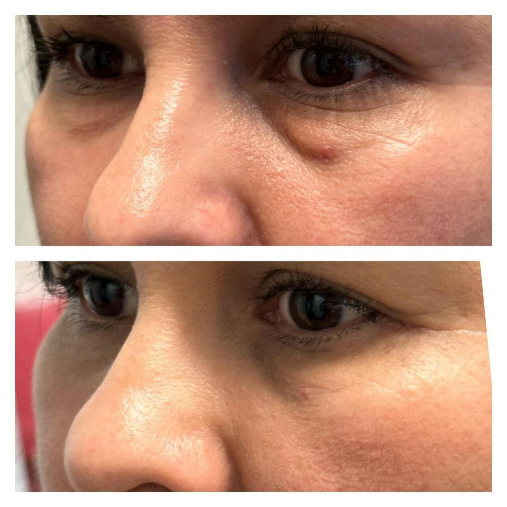 Lower Blepharoplasty Before & After Gallery - Patient 149283997 - Image 2