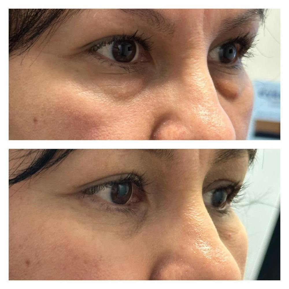 Lower Blepharoplasty Before & After Gallery - Patient 149283997 - Image 3