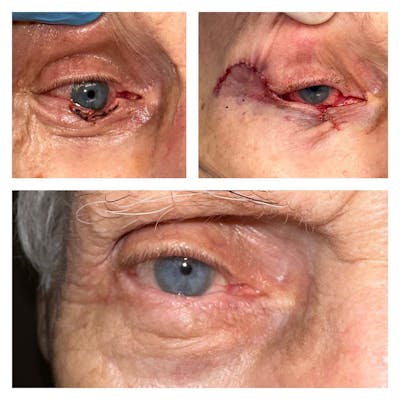 Eyelid Skin Cancer Removal (MOHS) Before & After Gallery - Patient 149284002 - Image 1