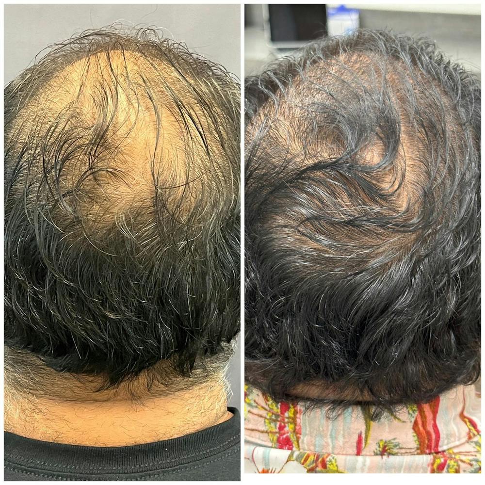 Hair Restoration  Before & After Gallery - Patient 149284005 - Image 1