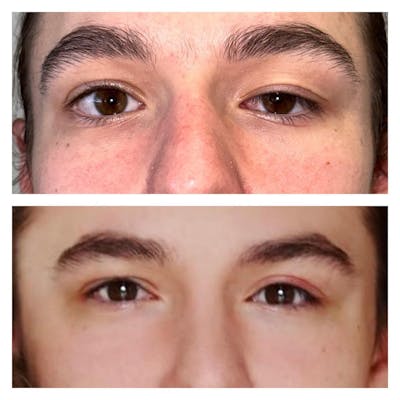 Ptosis Before & After Gallery - Patient 149284010 - Image 1