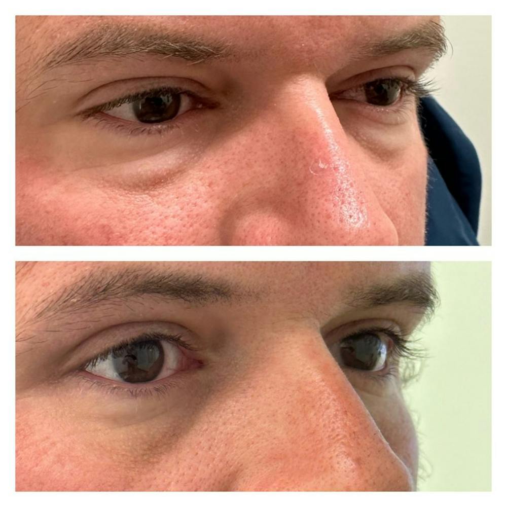 Lower Blepharoplasty Before & After Gallery - Patient 149284014 - Image 1