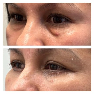 Lower Blepharoplasty Before & After Gallery - Patient 149284016 - Image 1