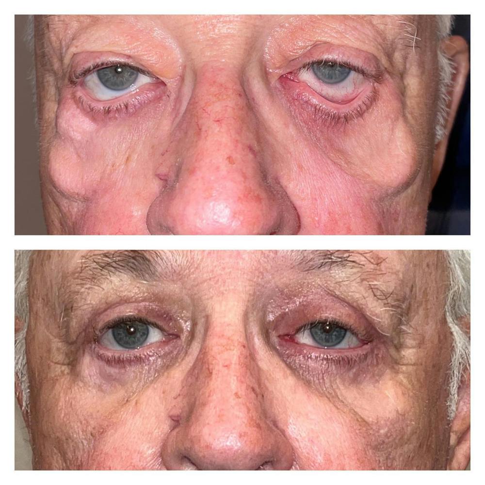 Eyelid Lift Before & After Gallery - Patient 149284021 - Image 1