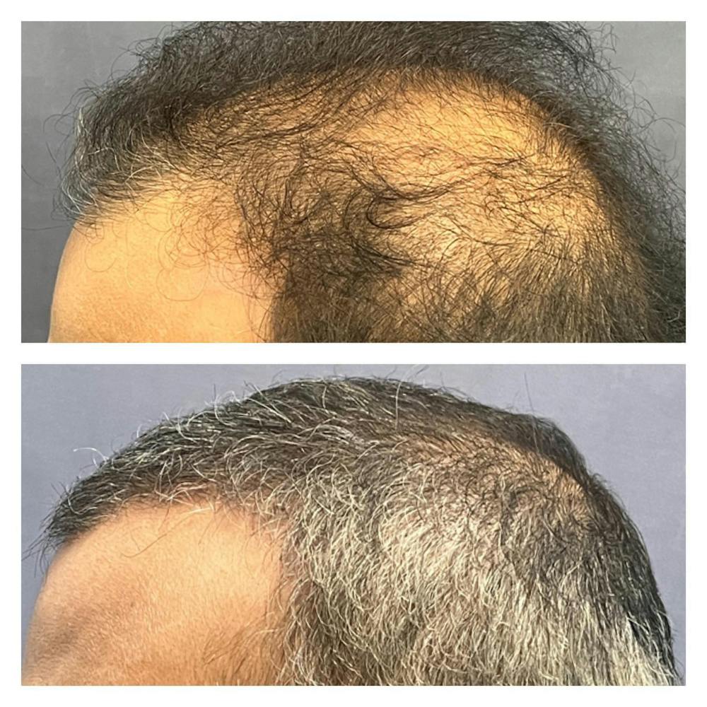 Hair Restoration  Before & After Gallery - Patient 149284036 - Image 1