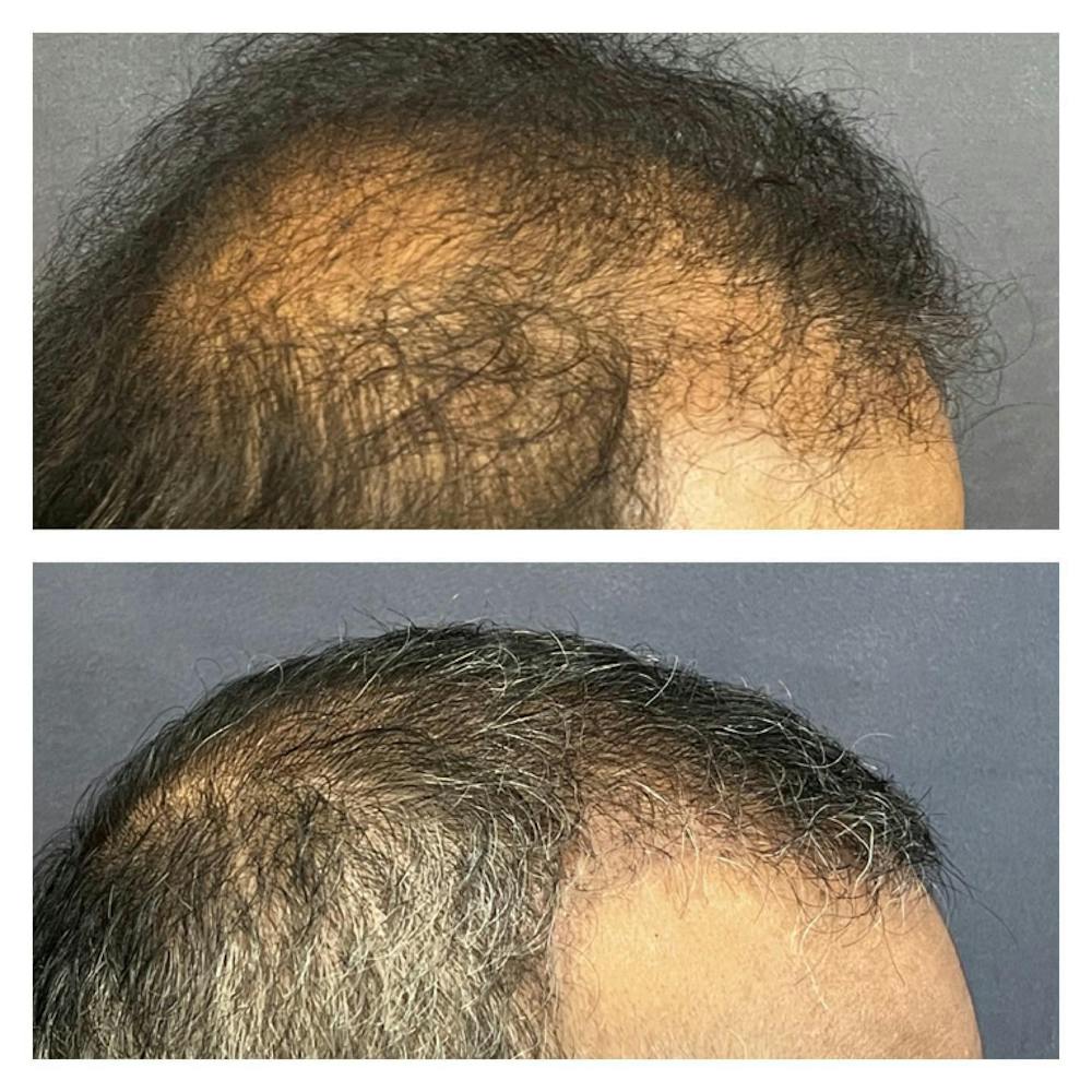 Hair Restoration  Before & After Gallery - Patient 149284036 - Image 2