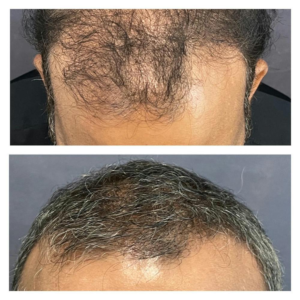 Hair Restoration  Before & After Gallery - Patient 149284036 - Image 3