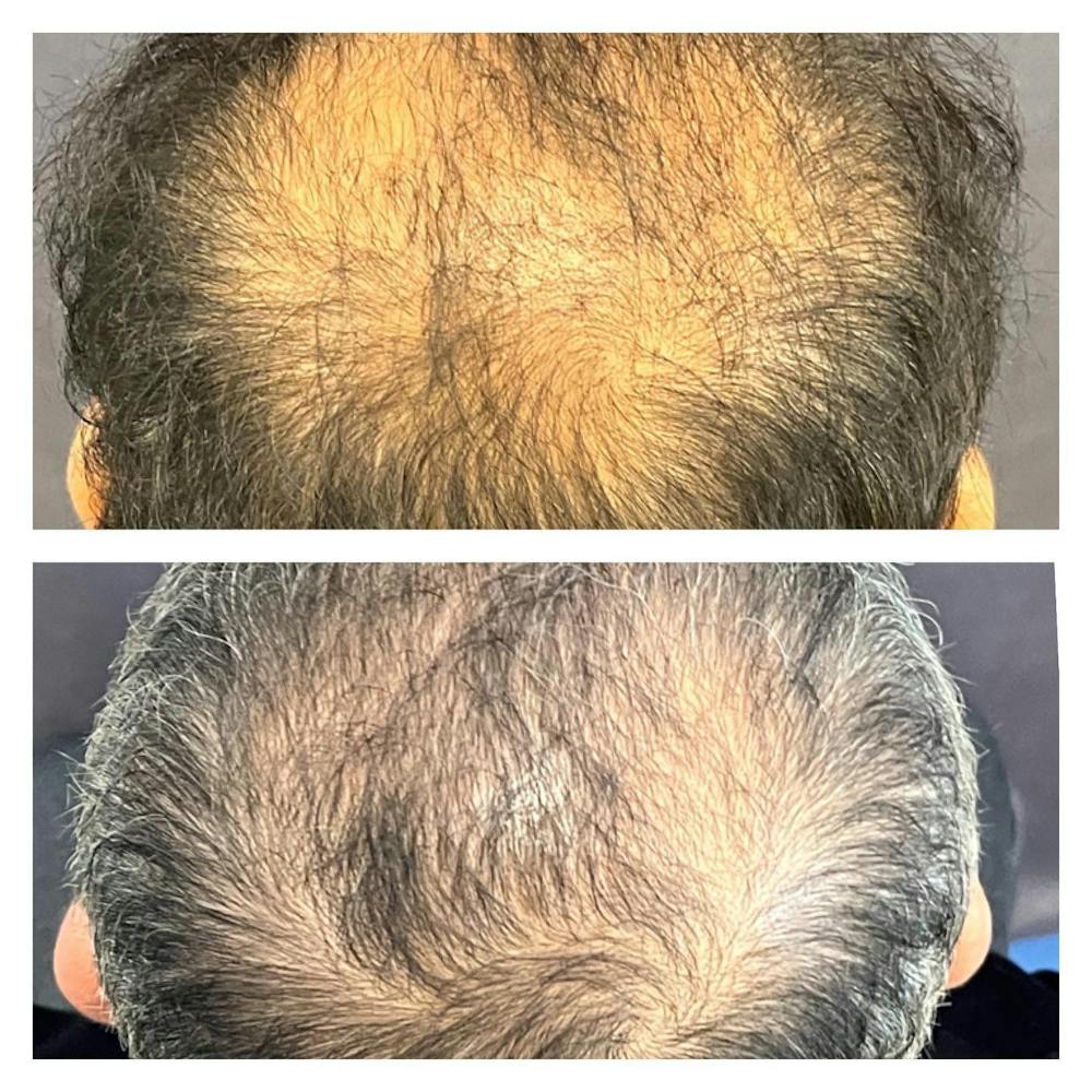 Hair Restoration  Before & After Gallery - Patient 149284036 - Image 4