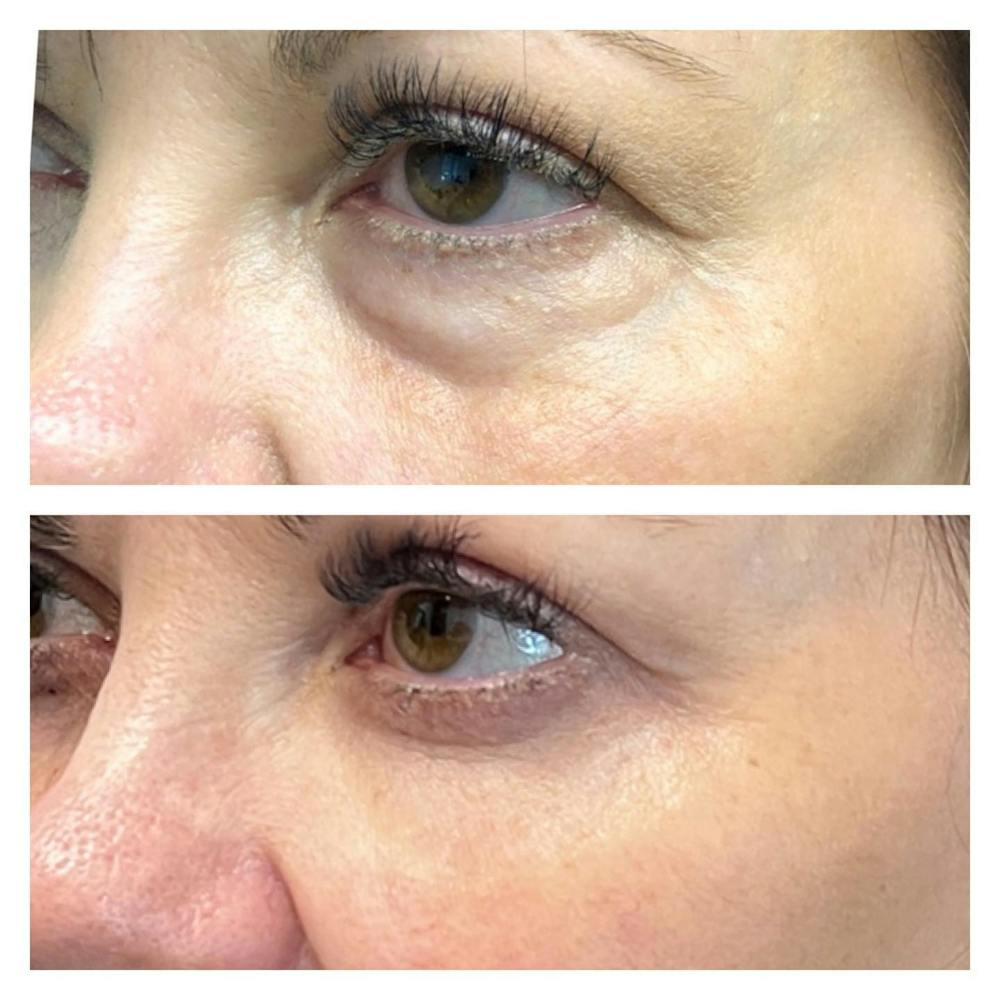 Lower Blepharoplasty Before & After Gallery - Patient 149284038 - Image 1