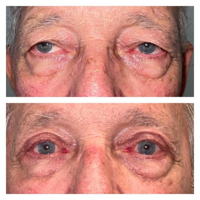 Ptosis Before & After Gallery - Patient 149284063 - Image 1