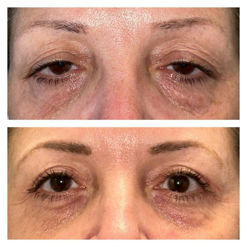 Ptosis Before & After Gallery - Patient 149284062 - Image 1