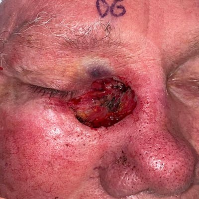 Eyelid Skin Cancer Removal (MOHS) Before & After Gallery - Patient 149284076 - Image 1