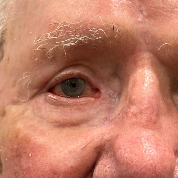 Eyelid Skin Cancer Removal (MOHS) Before & After Gallery - Patient 149284076 - Image 2