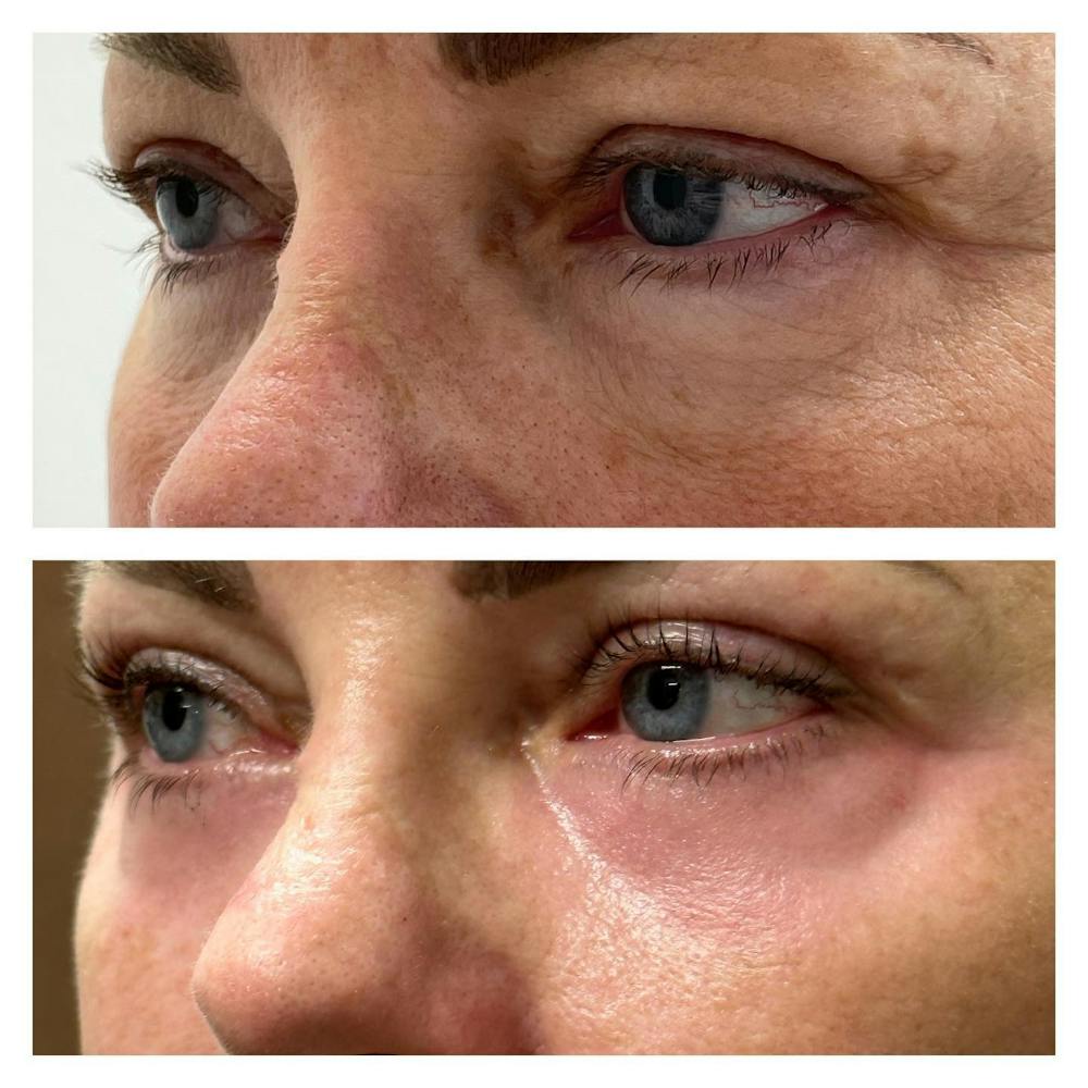 Upper Blepharoplasty Before & After Gallery - Patient 149284083 - Image 1