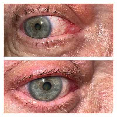 Lesions Before & After Gallery - Patient 149284106 - Image 1