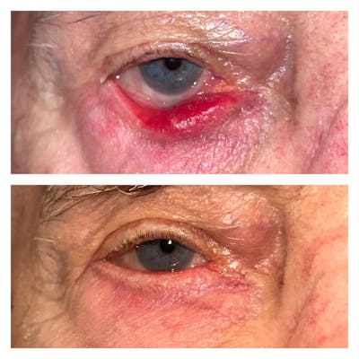 Ectropion Before & After Gallery - Patient 149284108 - Image 1