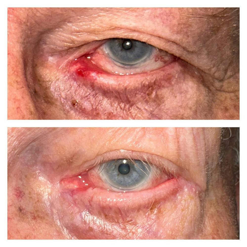 Ectropion Before & After Gallery - Patient 149284108 - Image 2