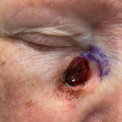 Eyelid Skin Cancer Removal (MOHS) Before & After Gallery - Patient 149284109 - Image 1