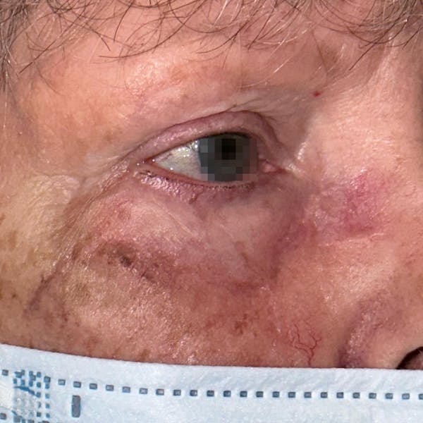 Eyelid Skin Cancer Removal (MOHS) Before & After Gallery - Patient 149284109 - Image 2
