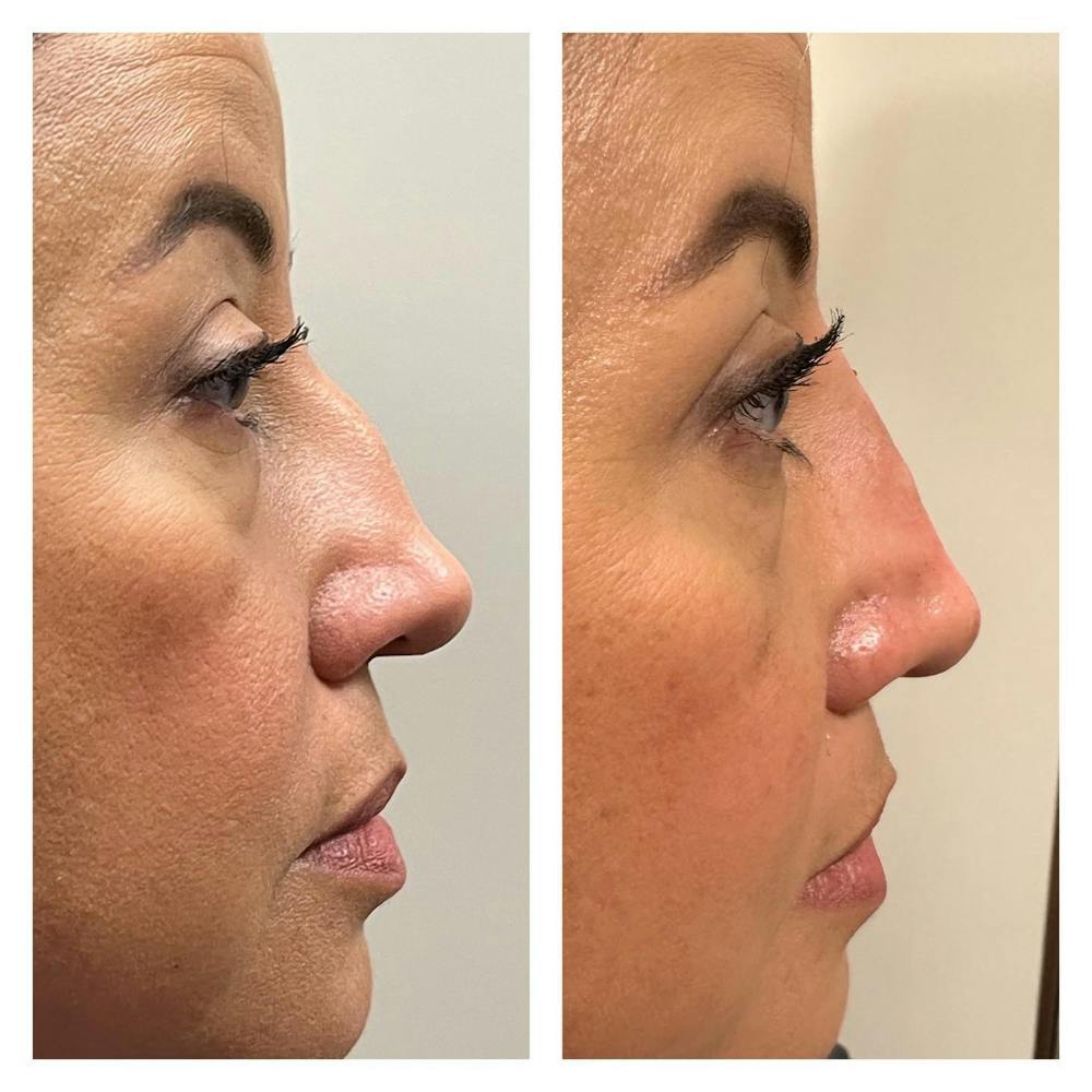Non-Surgical Rhinoplasty Before & After Gallery - Patient 384251 - Image 1
