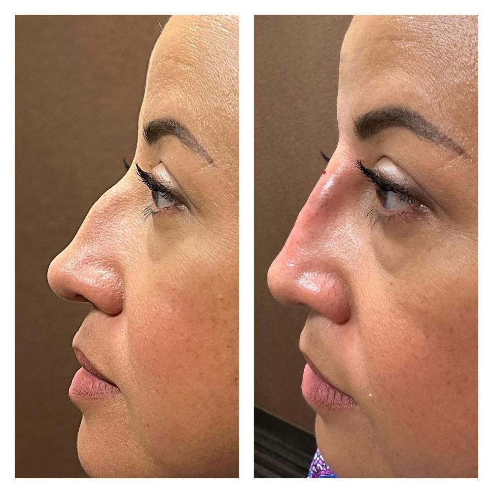 Non-Surgical Rhinoplasty Before & After Gallery - Patient 149284116 - Image 2
