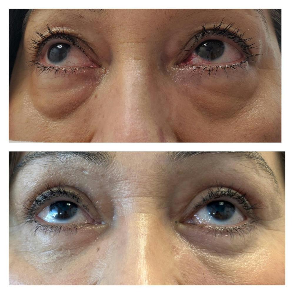 Lower Blepharoplasty Before & After Gallery - Patient 149284123 - Image 1