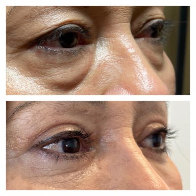 Lower Blepharoplasty Before & After Gallery - Patient 149284123 - Image 2
