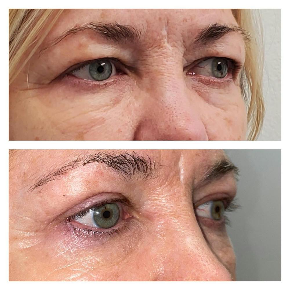 Upper Blepharoplasty Before & After Gallery - Patient 149284136 - Image 1