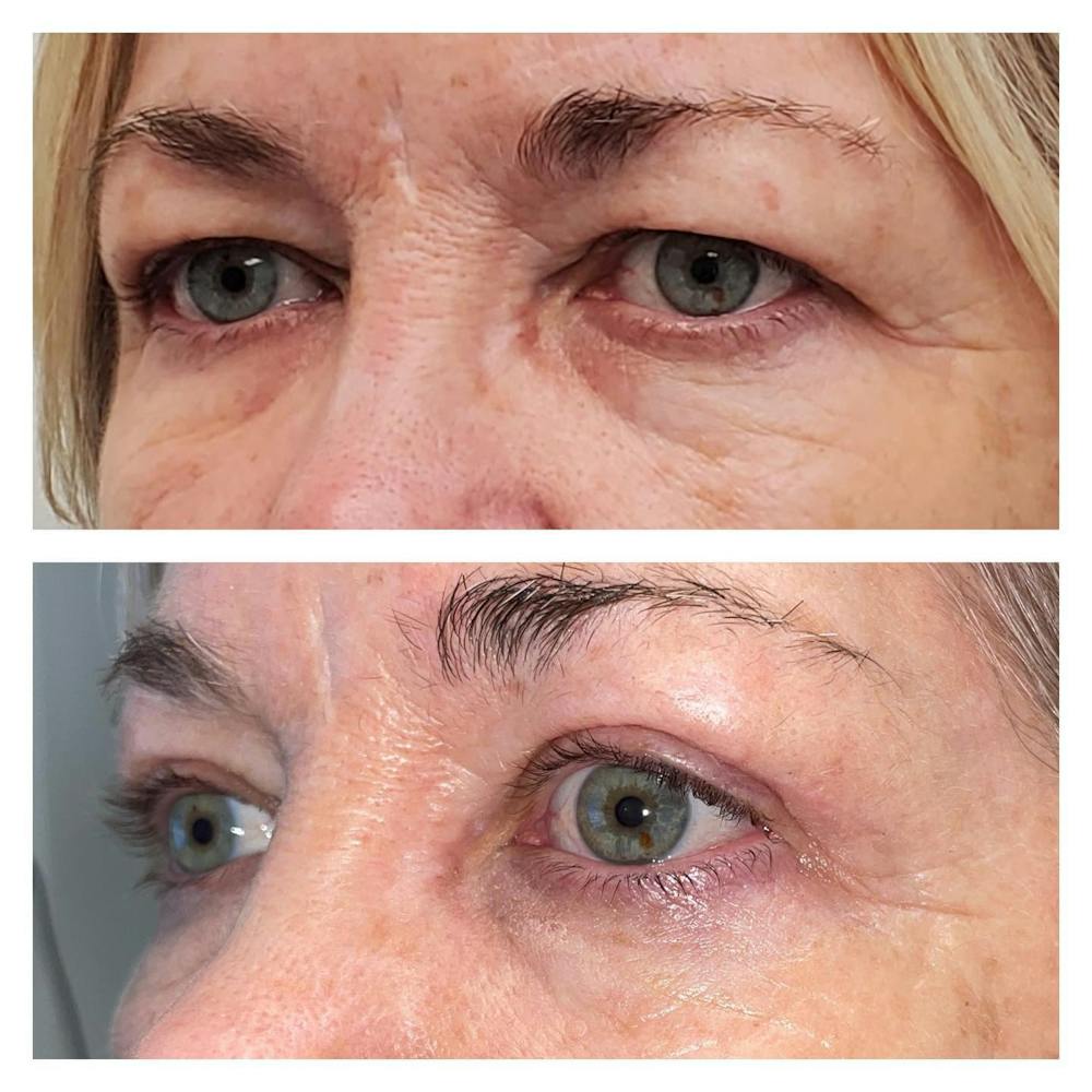 Upper Blepharoplasty Before & After Gallery - Patient 149284136 - Image 2