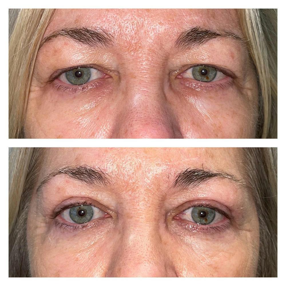 Upper Blepharoplasty Before & After Gallery - Patient 149284136 - Image 3