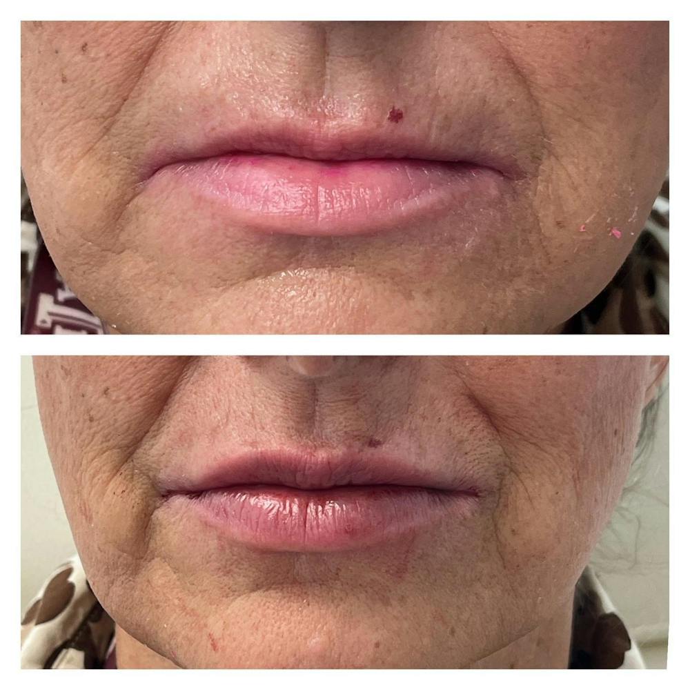 Lip Fillers Before & After Gallery - Patient 149284141 - Image 1