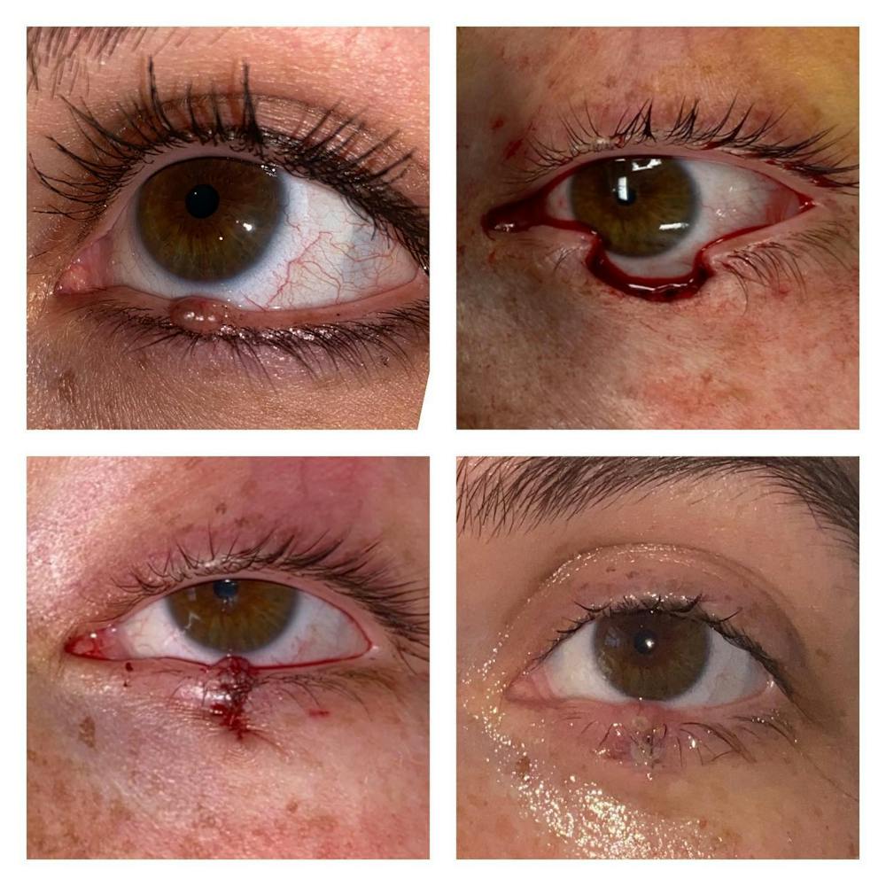 Eyelid Skin Cancer Removal (MOHS) Before & After Gallery - Patient 149284144 - Image 1