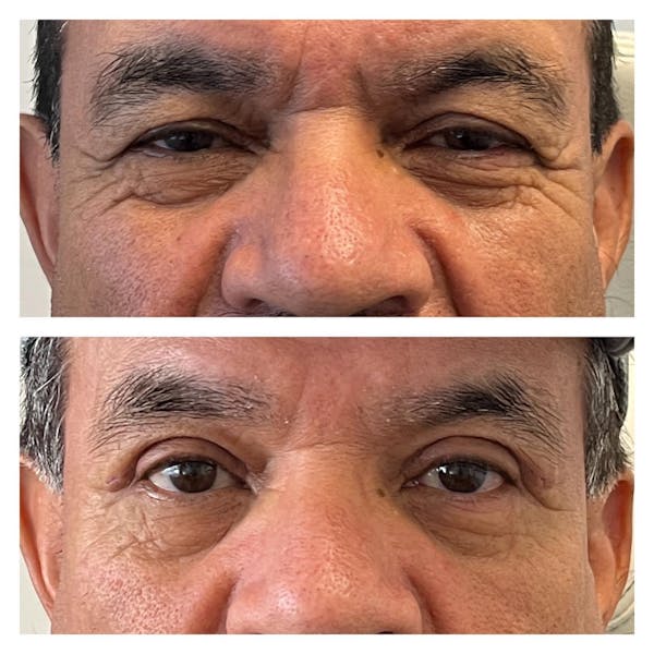 Upper Blepharoplasty Before & After Gallery - Patient 149284148 - Image 1
