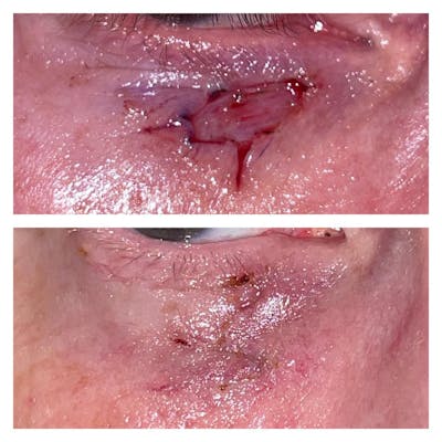 Eyelid Skin Cancer Removal (MOHS) Before & After Gallery - Patient 149284150 - Image 1