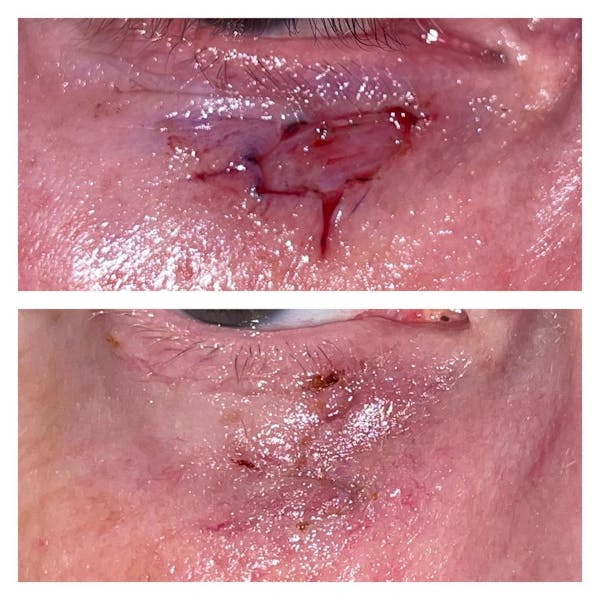 Eyelid Skin Cancer Removal (MOHS) Before & After Gallery - Patient 149284150 - Image 1