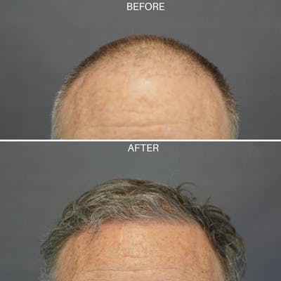 Hair Restoration  Before & After Gallery - Patient 149284157 - Image 1