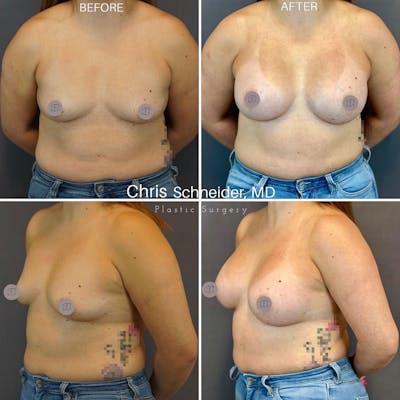 Breast Augmentation Before & After Gallery - Patient 149284163 - Image 1