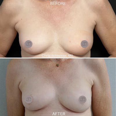 Breast Reconstruction  Before & After Gallery - Patient 149284164 - Image 1