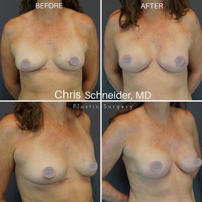 Breast Reconstruction  Before & After Gallery - Patient 149284174 - Image 1