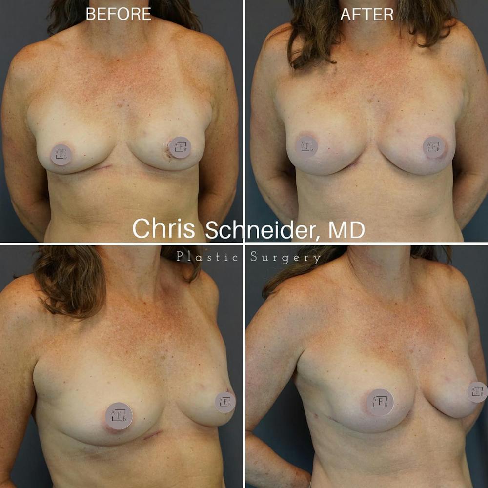 Breast Reconstruction  Before & After Gallery - Patient 149284174 - Image 1