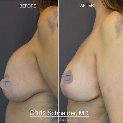 Breast Revision Before & After Gallery - Patient 149284176 - Image 1