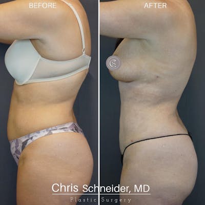Body Etching (High-Def Lipo) Before & After Gallery - Patient 149284186 - Image 1