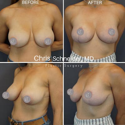 Breast Reduction Before & After Gallery - Patient 149284188 - Image 1